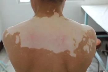 白癜风预防方法都有哪些?